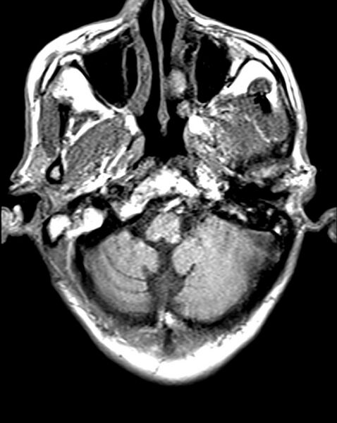 File:Brain abscess with dual rim sign (Radiopaedia 87566-103938 Axial T1 2).jpg