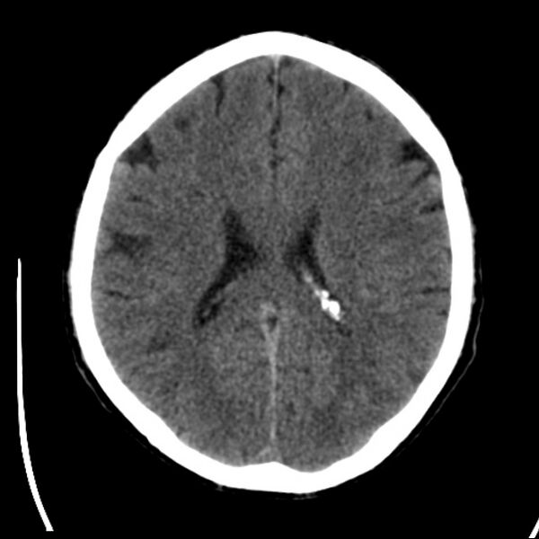 File:Brain metastases from lung cancer (Radiopaedia 24480-24781 Axial non-contrast 30).jpg