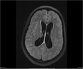 Brainstem glioma (Radiopaedia 21819-21775 Axial FLAIR 24).jpg