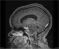 Brainstem glioma (Radiopaedia 21819-21775 D 18).jpg