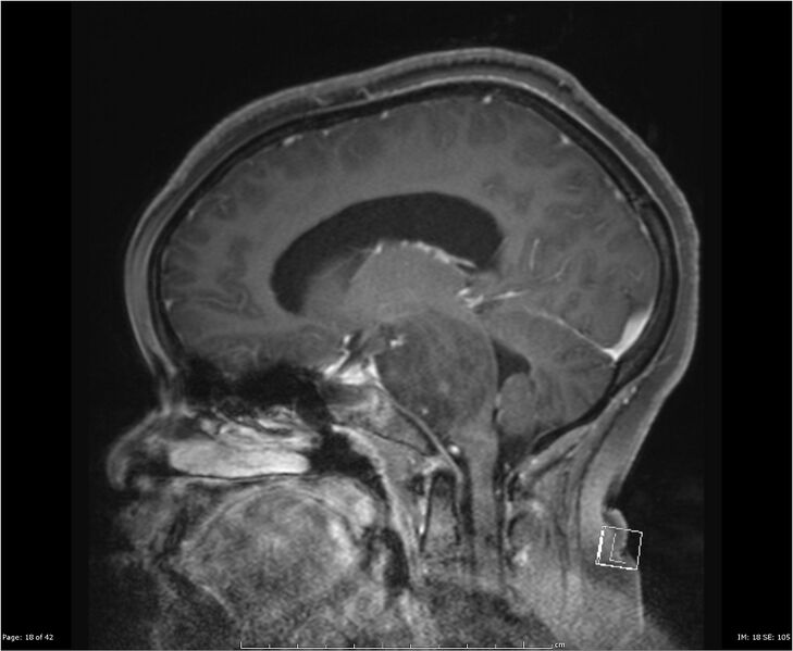 File:Brainstem glioma (Radiopaedia 21819-21775 D 18).jpg