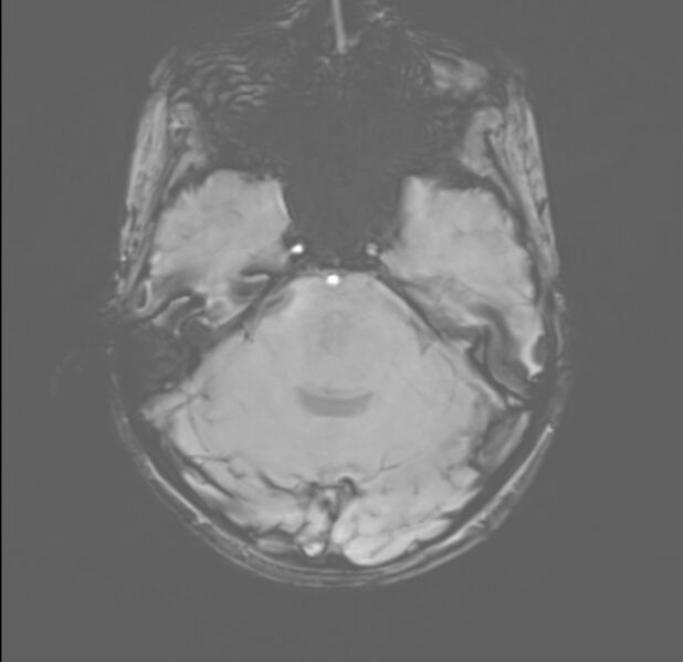 File:Brainstem glioma (Radiopaedia 70548-80674 Axial SWI 14).jpg