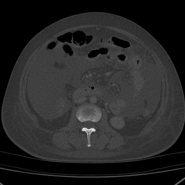 File:Breast cancer metastases - hepatic and skeletal (Radiopaedia 34201-35461 Axial bone window 62).jpg