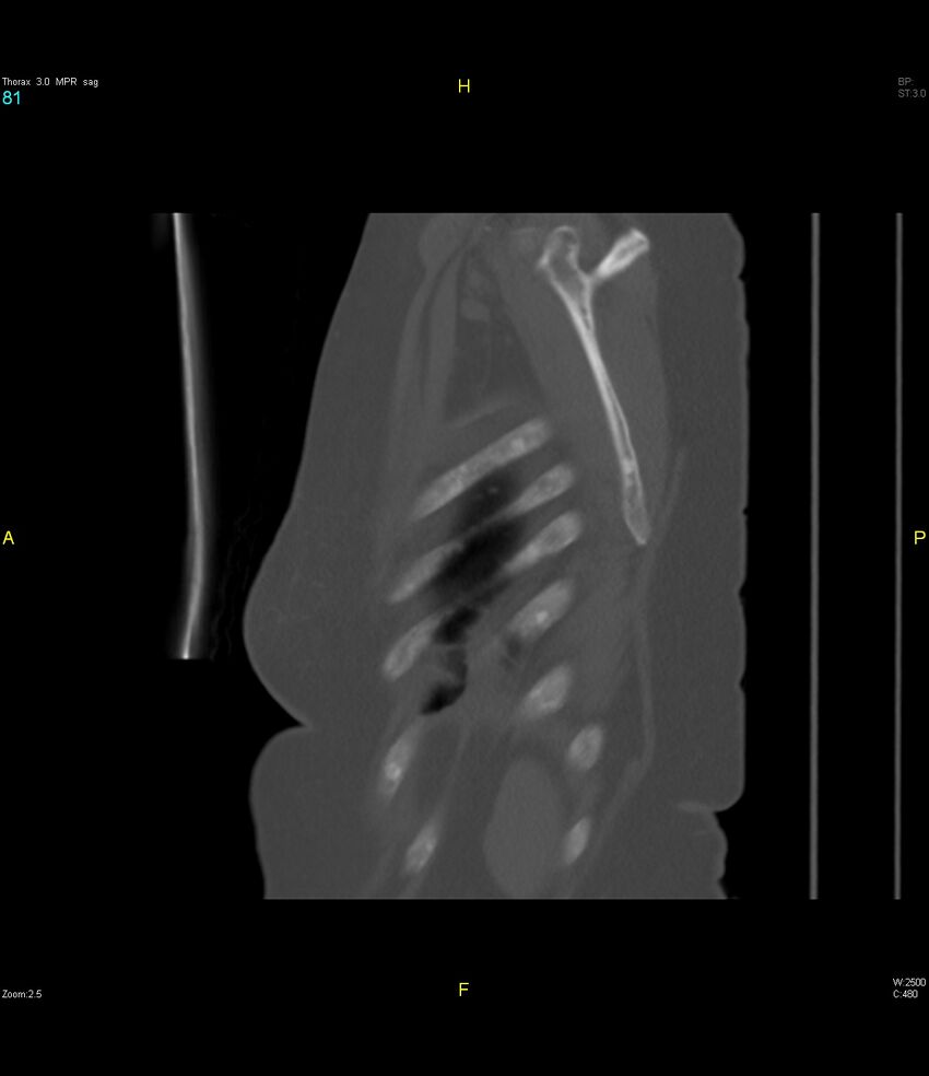 Breast primary with lung and bone metastases (Radiopaedia 40620-43228 Sagittal bone window 81).jpg
