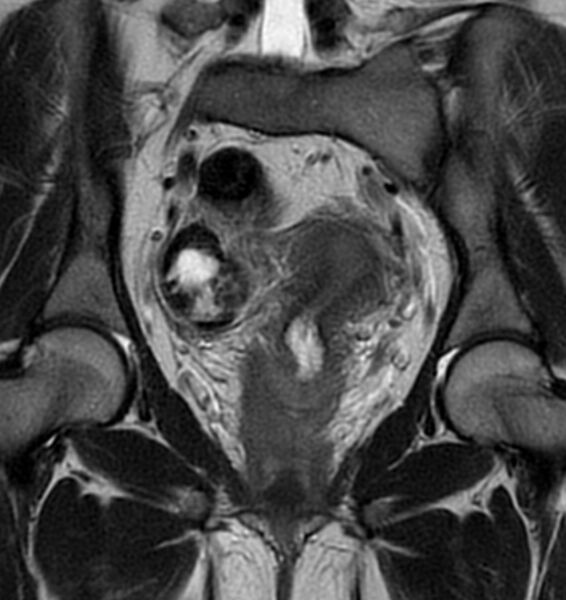 File:Broad ligament leiomyoma (Radiopaedia 81634-95516 Coronal T2 13).jpg