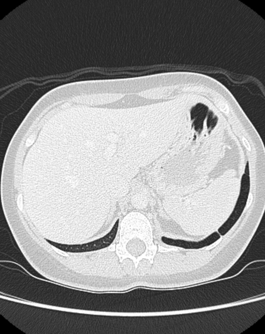 Bronchial atresia (Radiopaedia 50007-55297 Axial lung window 107).jpg