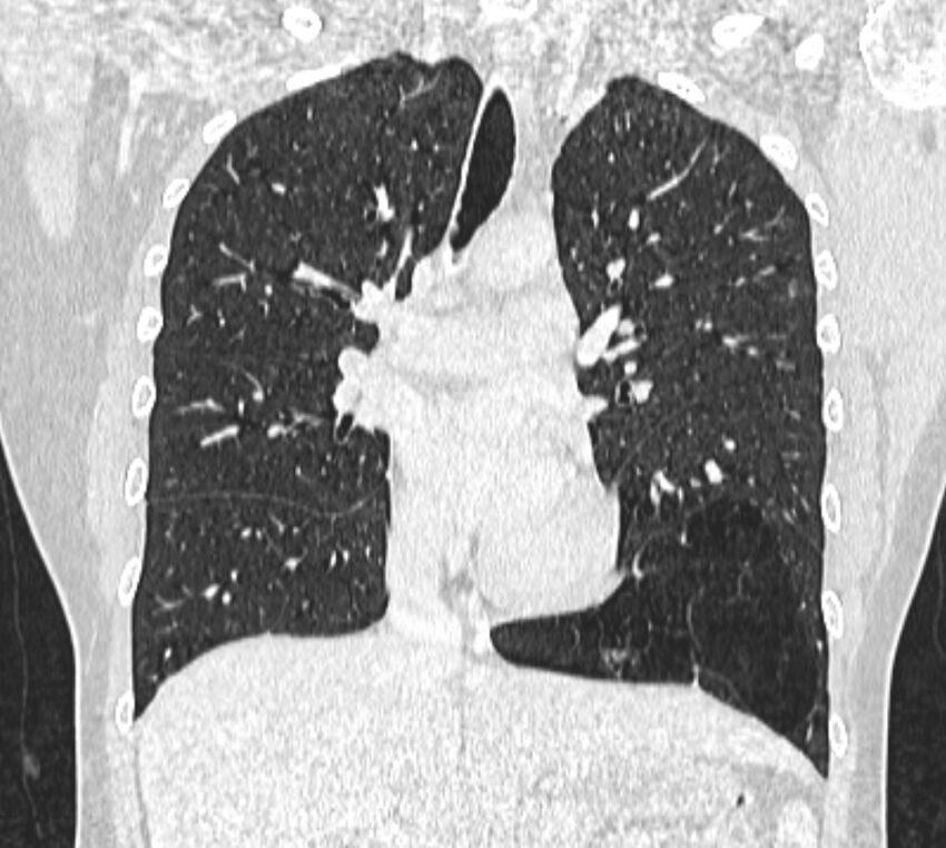Bronchial atresia (Radiopaedia 50007-55297 Coronal lung window 48).jpg