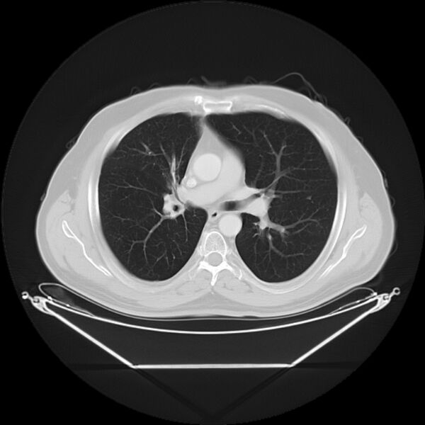 File:Bronchogenic carcinoma with upper lobe collapse (Radiopaedia 29297-29726 Axial lung window 16).jpg