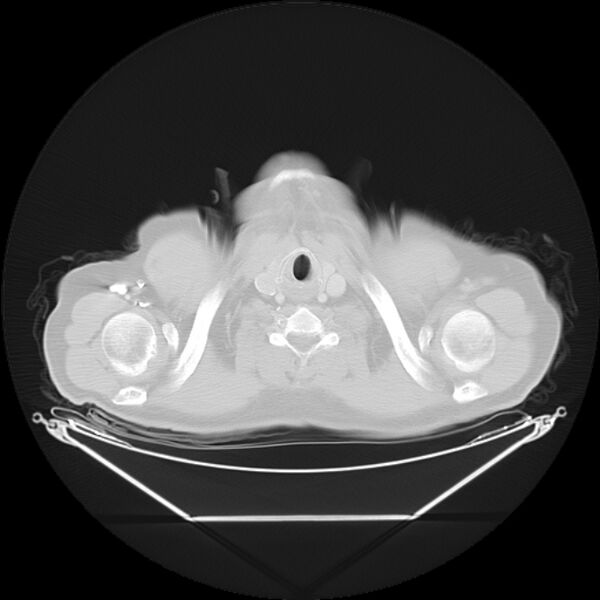 File:Bronchogenic carcinoma with upper lobe collapse (Radiopaedia 29297-29726 Axial lung window 2).jpg