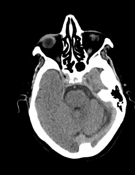 File:Burnt-out meningioma (Radiopaedia 51557-57337 Axial non-contrast 12).jpg