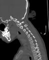 Butterfly vertebra (Radiopaedia 77903-90209 Sagittal bone window 69).jpg