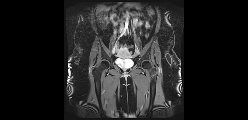 Buttock filler complications (Radiopaedia 63497-72115 Coronal T1 C+ 12).jpg