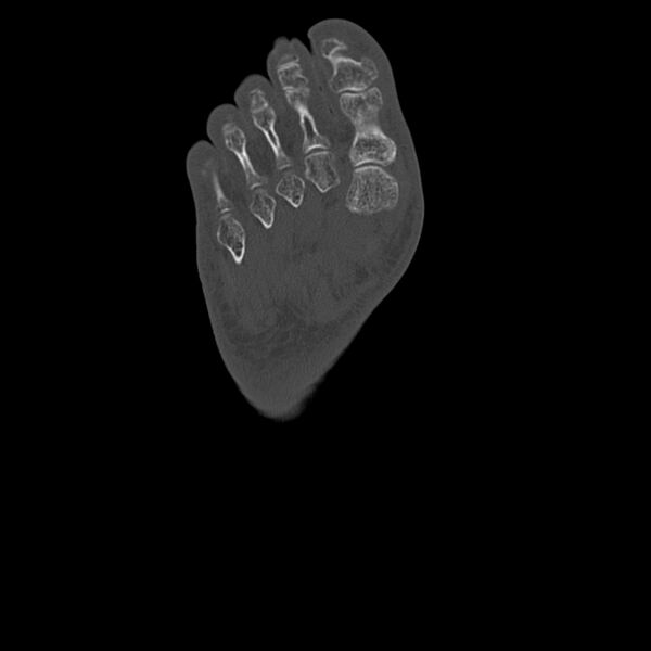 File:Calcaneal tuberosity avulsion fracture (Radiopaedia 22649-22668 Axial bone window 51).jpg