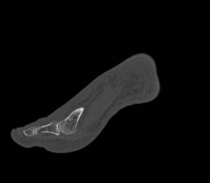 File:Calcaneal tuberosity avulsion fracture (Radiopaedia 22649-22668 Sagittal bone window 45).jpg