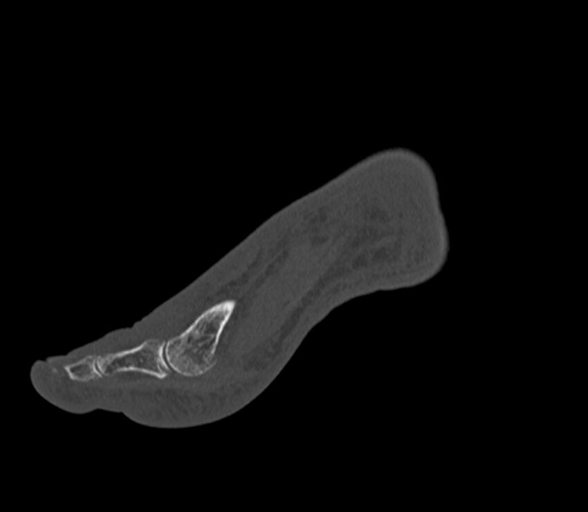 Calcaneal tuberosity avulsion fracture (Radiopaedia 22649-22668 Sagittal bone window 45).jpg