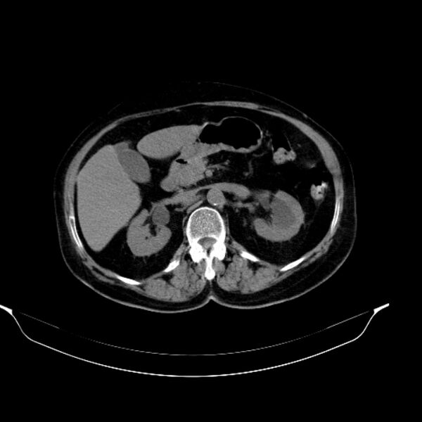 File:Calcified hydatid cyst (Radiopaedia 62000-70085 Axial non-contrast 42).jpg