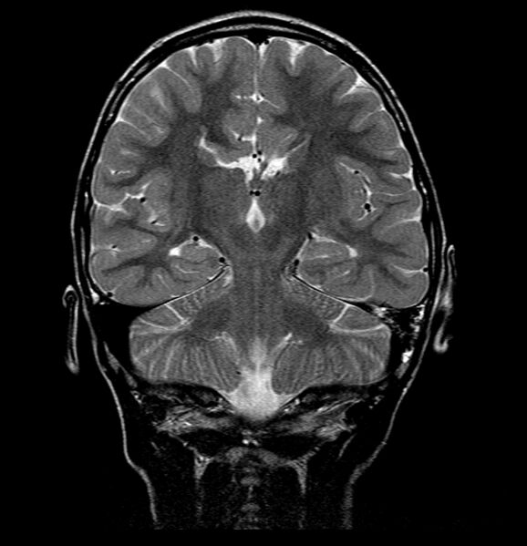 File:Callosal dysgenesis and ectopic posterior pituitary (Radiopaedia 8382-9213 Coronal T2 2).jpg