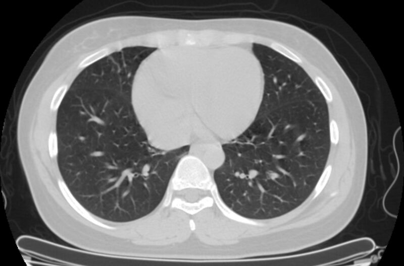 File:Cannonball metastases - uterine choriocarcinoma (Radiopaedia 70137-80173 Axial lung window 76).jpg