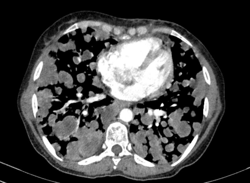 File:Cannonball metastases from breast cancer (Radiopaedia 91024-108569 A 78).jpg