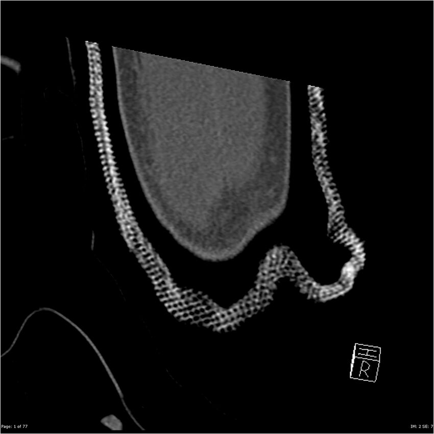 Capitellum fracture (Radiopaedia 23352-23426 Coronal bone window 1).jpg