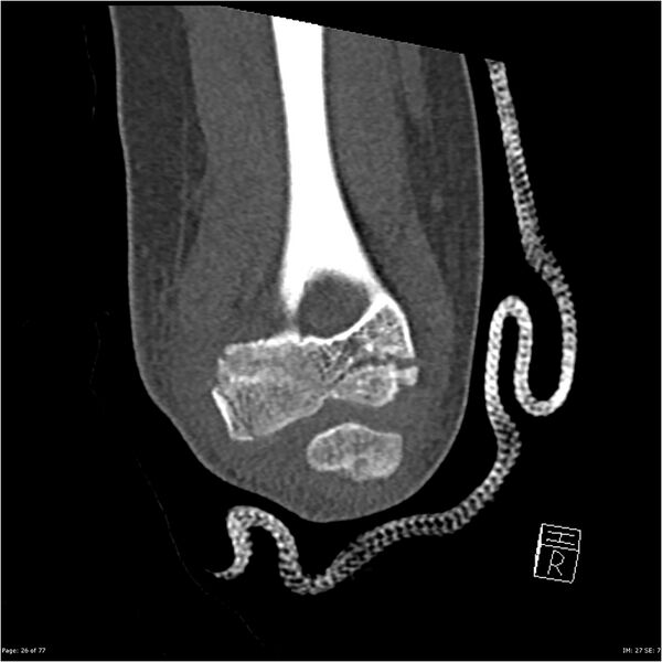 File:Capitellum fracture (Radiopaedia 23352-23426 Coronal bone window 26).jpg