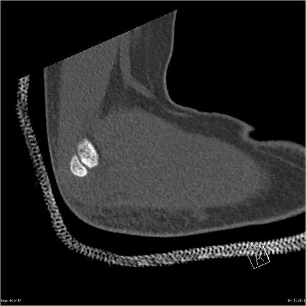 File:Capitellum fracture (Radiopaedia 23352-23426 Sagittal bone window 50).jpg