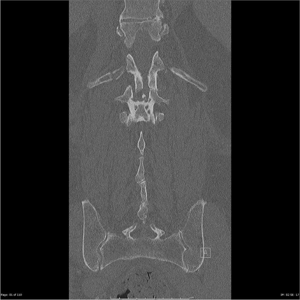 File:Cardiac trauma (Radiopaedia 32874-33858 Coronal bone window 81).jpg