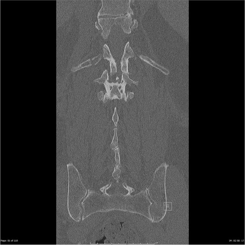 Cardiac trauma (Radiopaedia 32874-33858 Coronal bone window 81).jpg