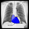 Cardiomediastinal anatomy on chest radiography (annotated images) (Radiopaedia 46331-50742 Q 3).png