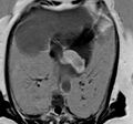 Caseous calcification of the mitral valve annulus (Radiopaedia 47717-52411 E 1).jpg