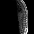 Caudal regression syndrome (Radiopaedia 61990-70072 Sagittal T1 5).jpg