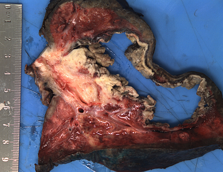 File:Cavitating lung mass - squamous cell carcinoma (Radiopaedia 48047-52856 Gross pathology 1).png