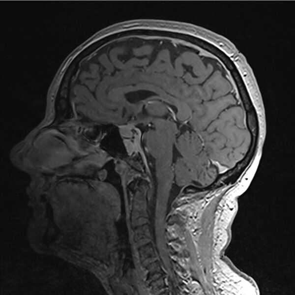 File:Central base of skull meningioma (Radiopaedia 53531-59549 Sagittal T1 C+ 22).jpg