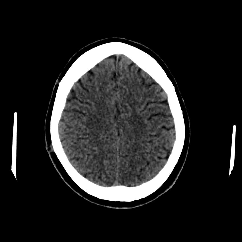 Central nervous system Langerhans cell histiocytosis (Radiopaedia 65728-74878 Axial non-contrast 40).jpg