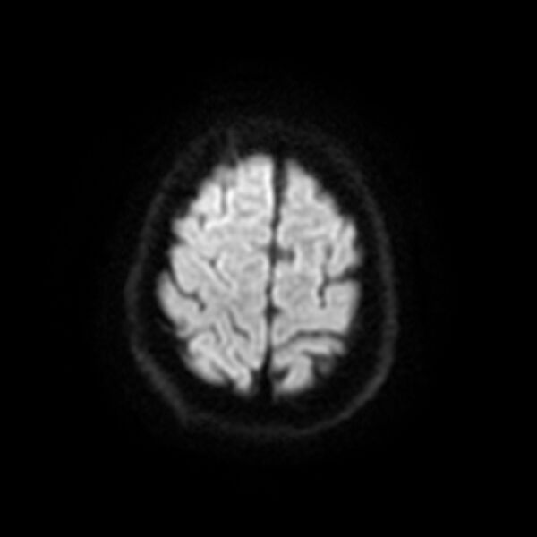 File:Central neurocytoma (Radiopaedia 67618-77021 Axial DWI 20).jpg