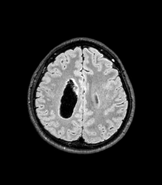 File:Central neurocytoma (Radiopaedia 79320-92380 Axial FLAIR 101).jpg