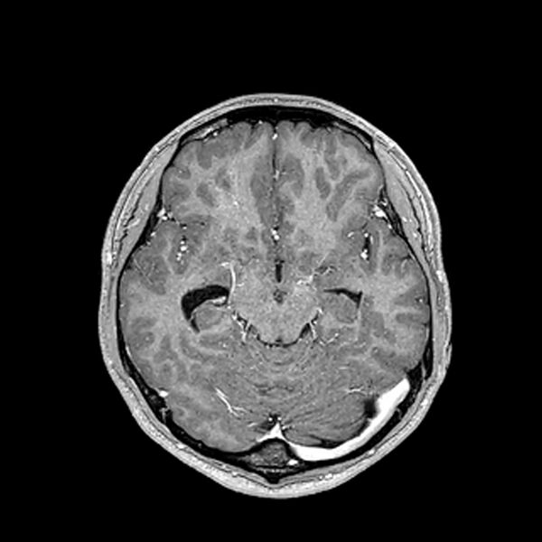 File:Central neurocytoma (Radiopaedia 79320-92380 Axial T1 C+ 105).jpg