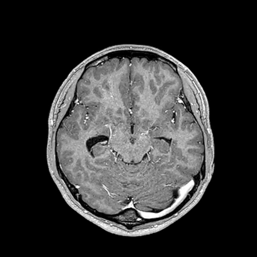 Central neurocytoma (Radiopaedia 79320-92380 Axial T1 C+ 105).jpg