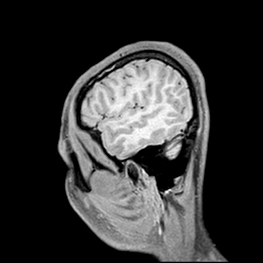 Central neurocytoma (Radiopaedia 79320-92380 Sagittal T1 218).jpg