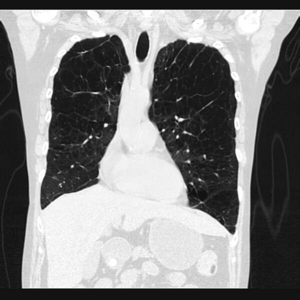 File:Centrilobular pulmonary emphysema (Radiopaedia 24495-24789 Coronal lung window 25).jpg