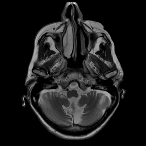 File:Cerebellar ataxia with neuropathy and vestibular areflexia syndrome (CANVAS) (Radiopaedia 74283-85159 Axial T2 5).jpg