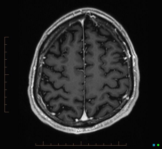 File:Cerebellar gangliocytoma (Radiopaedia 65377-74422 Axial T1 C+ 114).jpg