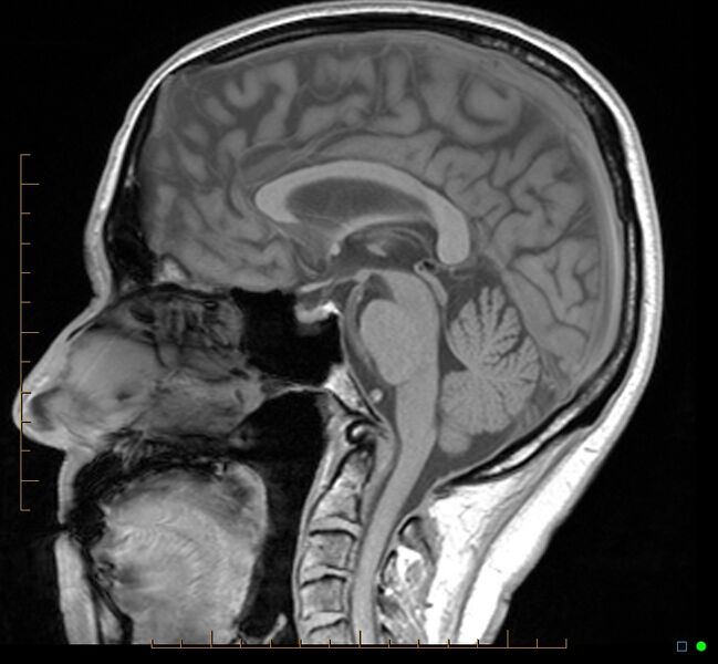 File:Cerebellar gangliocytoma (Radiopaedia 65377-74422 Sagittal T1 22).jpg
