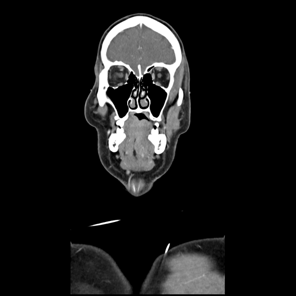 File:Cerebellar infarct due to vertebral artery dissection with posterior fossa decompression (Radiopaedia 82779-97029 D 13).png