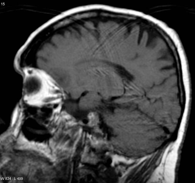 File:Cerebral absceses (Radiopaedia 4933-6838 Sagittal T1 1).jpg