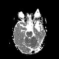Cerebral abscess post cardiac surgery (Radiopaedia 27244-27420 Axial ADC 8).jpg