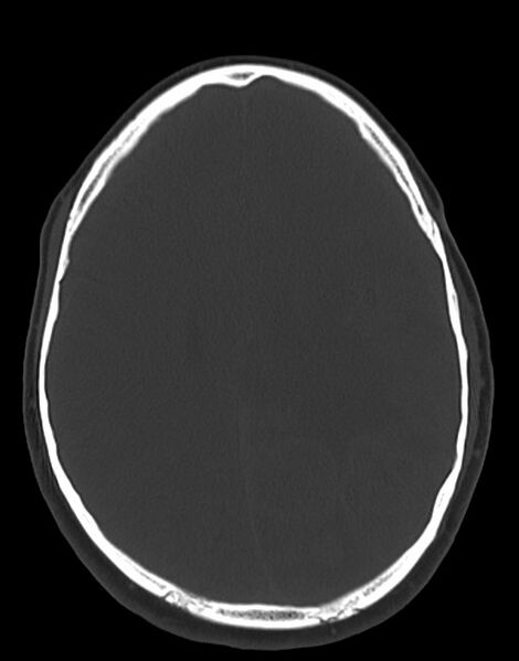 File:Cerebral abscesses (Radiopaedia 70458-80568 Axial bone window 40).jpg