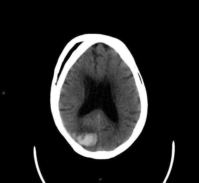 File:Cerebral amyloid angiopathy-associated lobar intracerebral hemorrhage (Radiopaedia 58377-65514 Axial non-contrast 20).jpg