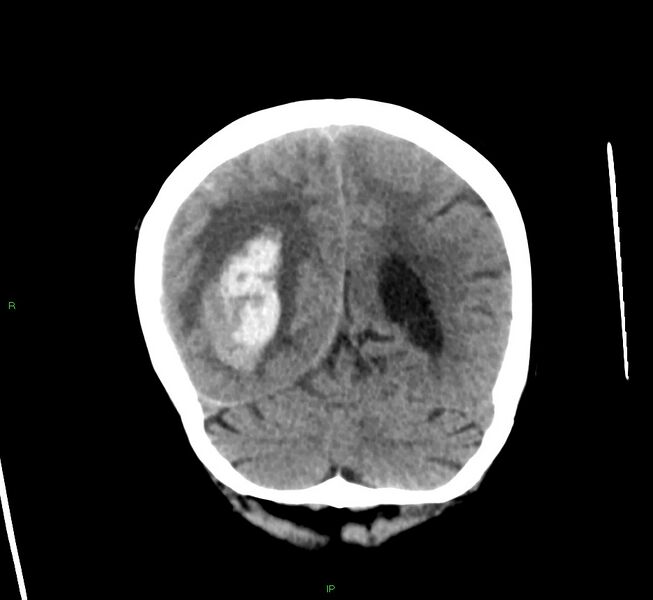 File:Cerebral amyloid angiopathy-associated lobar intracerebral hemorrhage (Radiopaedia 58563-65727 Coronal non-contrast 21).jpg