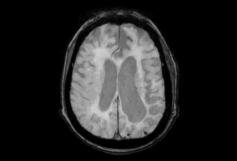 File:Cerebral amyloid angiopathy (Radiopaedia 86671-102792 Axial Gradient Echo 20).jpg